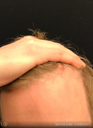 Neograft Hair transplantation