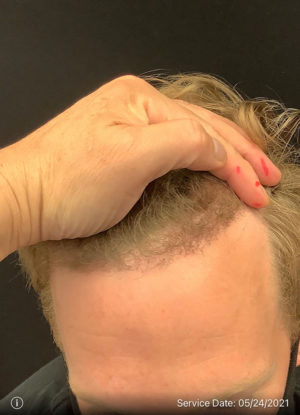 Neograft Hair transplantation