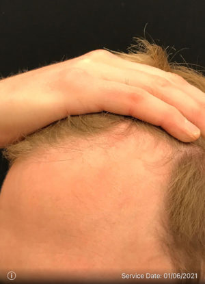 Neograft Hair transplantation