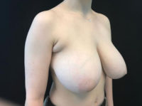 Breast Reduction