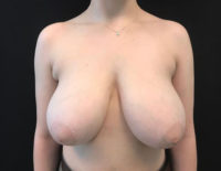 Breast Reduction