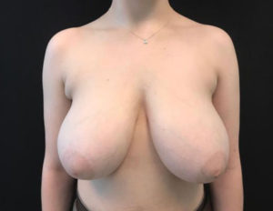 Breast Reduction