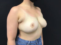 Breast Reduction