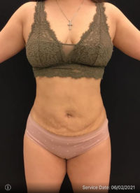 Liposuction