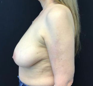 Breast Reduction
