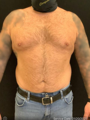 Gynecomastia