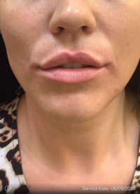 Fillers