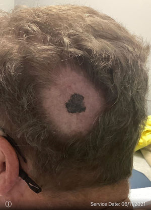 Malignant Melanoma