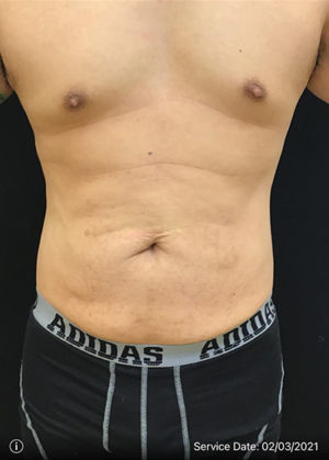 Tummy Tuck