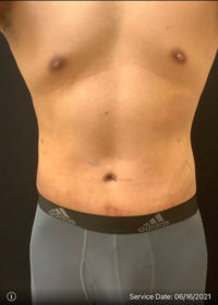 Tummy Tuck