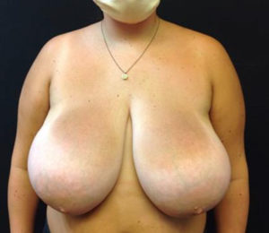 Breast Reduction