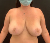 Breast Reduction