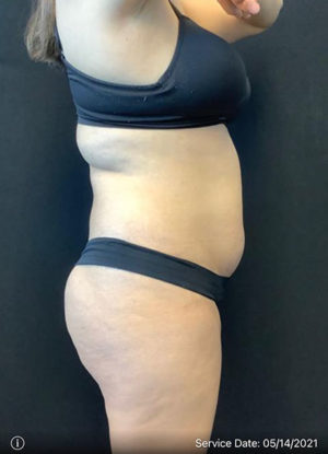 Liposuction