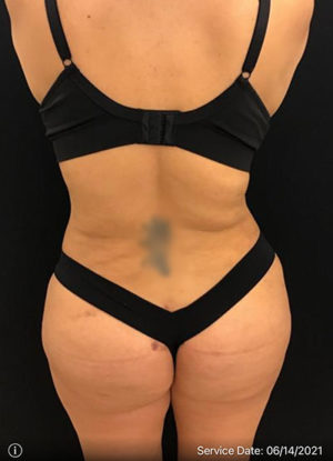 Liposuction