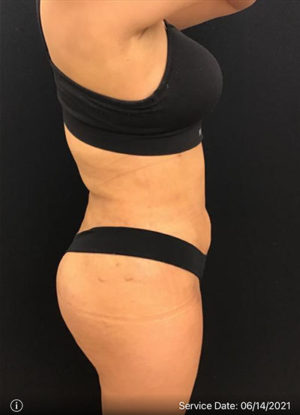 Liposuction