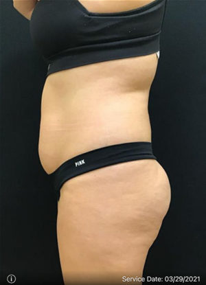 Liposuction