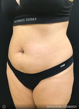 Liposuction