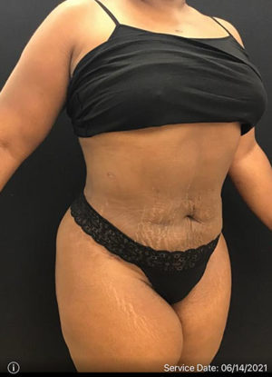 Liposuction