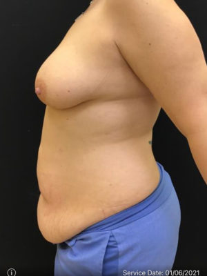 Tummy Tuck