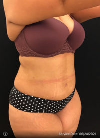 Tummy Tuck