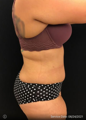 Tummy Tuck