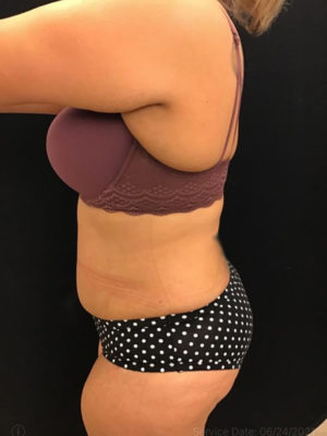 Tummy Tuck