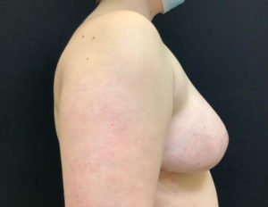 Breast Reduction