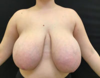 Breast Reduction