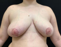 Breast Reduction