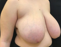 Breast Reduction