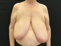 Breast Reduction