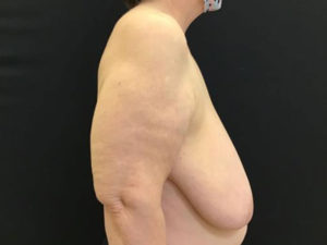 Breast Reduction