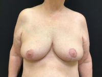 Breast Reduction