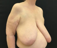 Breast Reduction