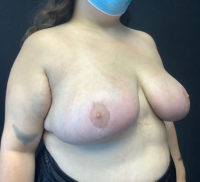 Breast Reduction