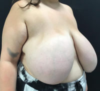 Breast Reduction