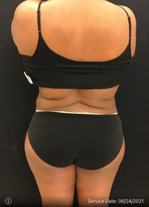 Liposuction