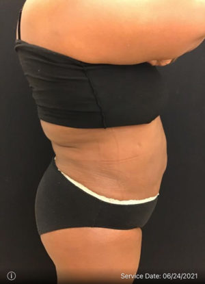 Liposuction