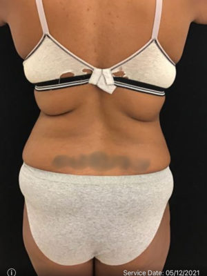 Liposuction