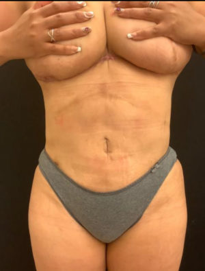 Tummy Tuck