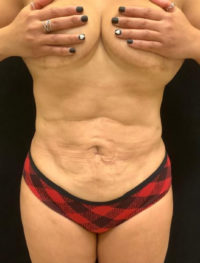 Tummy Tuck