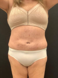 Tummy Tuck