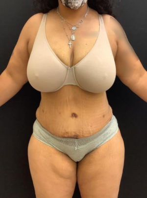 Tummy Tuck