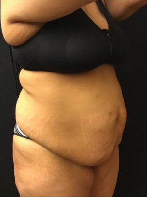 Tummy Tuck