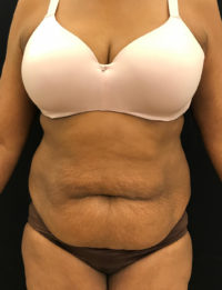 Liposuction