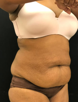 Liposuction