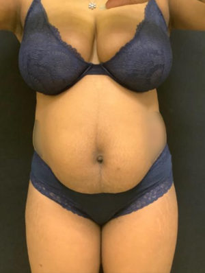 Liposuction