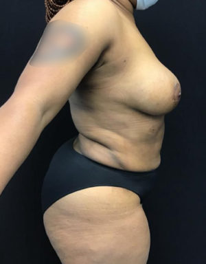 Breast Augmentation