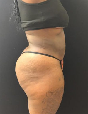 Liposuction