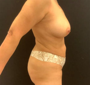 Fat Grafting to Breast